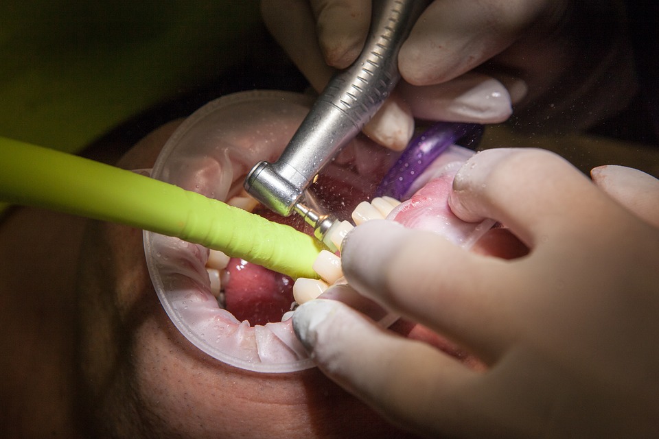 Teeth whitening